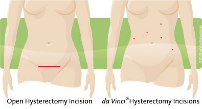 Incision comparison